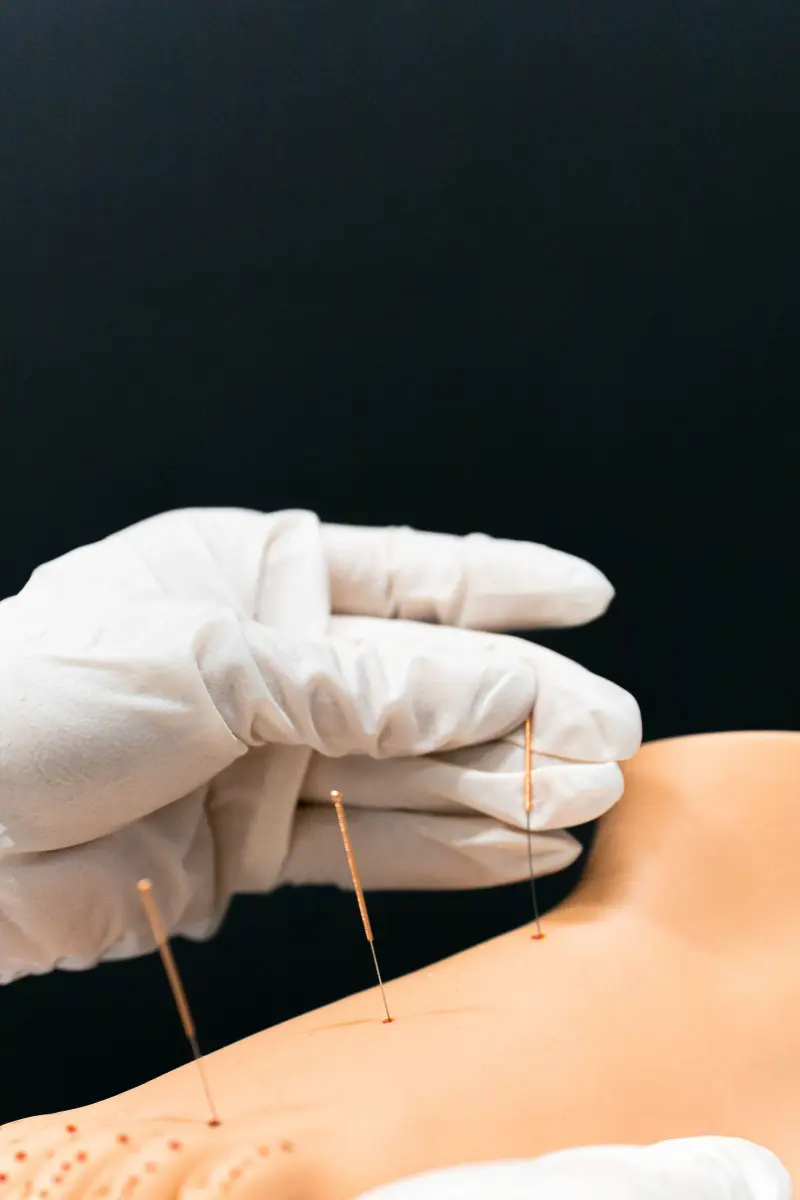 Dry needling